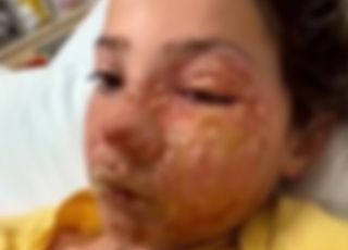 Menina de 10 anos sofre queimaduras no rosto após participar de desafio viral