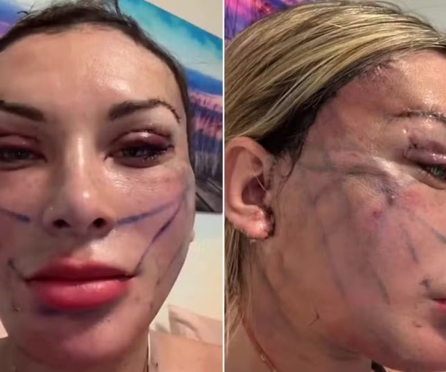 Andressa Urach exibe novo rosto após cirurgia de R$ 240 mil e chama atenção nas redes sociais. VEJA VÍDEO