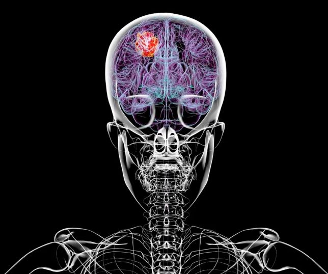 Alerta para mulheres: estudo aponta possível ligação entre contraceptivos hormonais e tumor cerebral raro