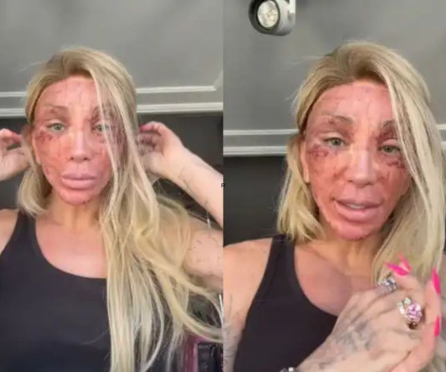 Maya Massafera assusta ao mostrar rosto inchado após peeling: 'Nunca inchou tanto'
