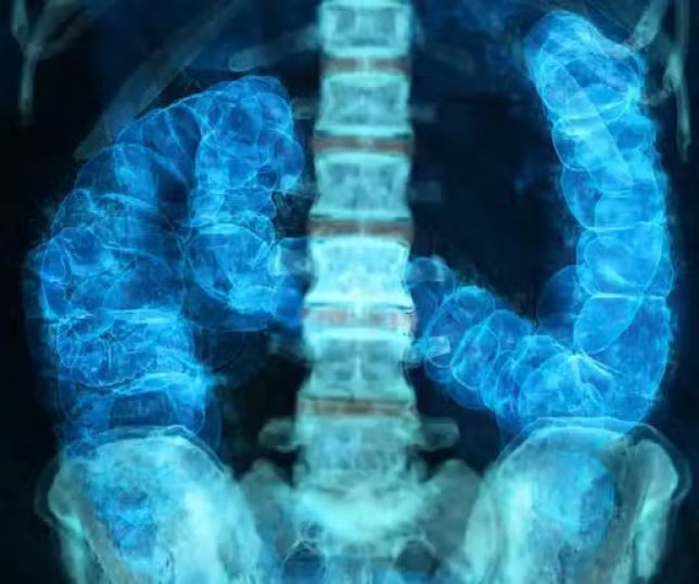 Câncer de intestino pode ser curado em mais de 90% dos casos quando descoberto cedo; veja os sinais de alerta