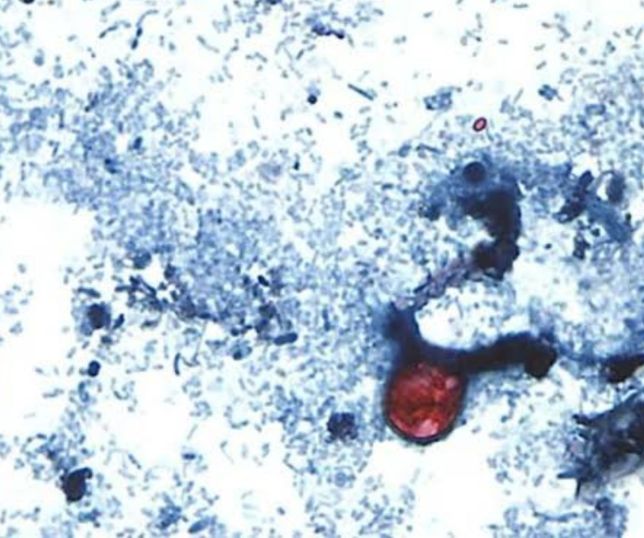 Surto de parasita ligado à alface contaminada já atinge nove estados dos Estados Unidos 