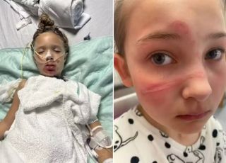 Trend viral com brinquedo termina em explosões e queimaduras graves em crianças