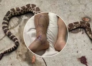 Picado duas vezes por cascavel, homem recebe 54 doses de soro e esgota estoque de hospital nos Estados Unidos