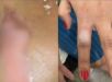 Mulher é incendiada pelo companheiro após pintar as unhas de vermelho