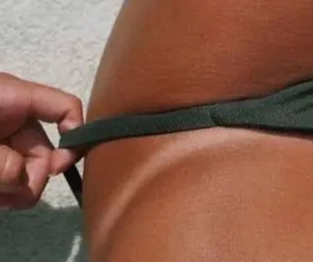 Marquinha de biquíni não é sinal de saúde: bronzeado revela dano causado pelo sol, alerta dermatologista