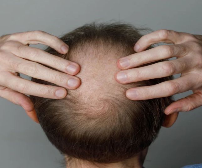 CALVÍCIE NÃO TEM CURA CASEIRA: Veja cuidados que podem ajudar a conter a queda