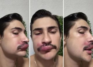 Influenciador é internado após espremer espinha no rosto e faz alerta sobre o triângulo da morte
