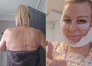 ‘Noiva de Frankenstein’: influencer gasta R$ 57 mil em primeira cirurgia e passa por transformação radical em apenas um ano