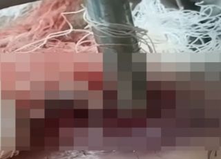 IMAGENS FORTES! Vídeo mostra homem com perna tomada por ‘tapurus’ em feridas ao redor de fixador externo. VEJA