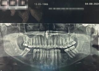 Paciente encontra agulha de sutura presa na gengiva após extração de dente no Rio de Janeiro 