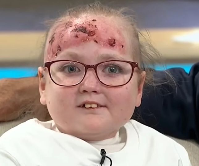 Doença rara faz menina de 14 anos conviver com bolhas e dor constante