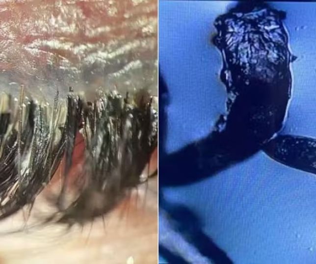 Extensão de cílios pode estar ligada a ácaros, irritação e problemas nas glândulas dos olhos