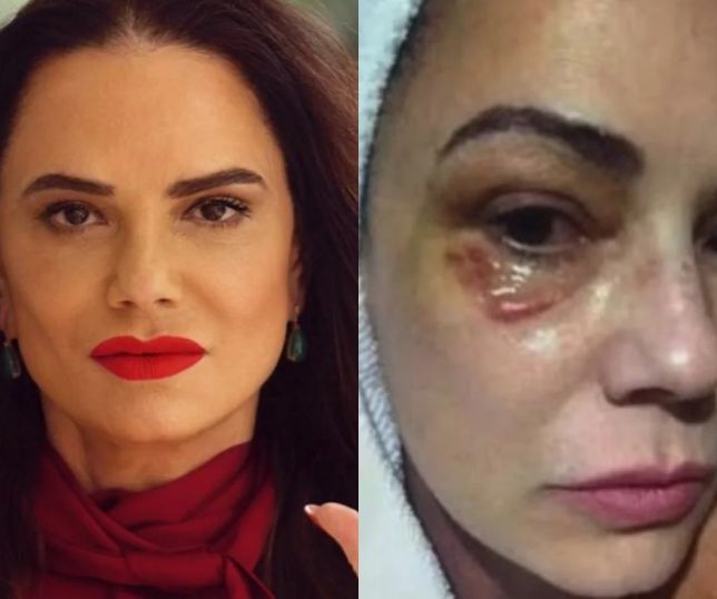 Luiza Brunet critica valor de indenização após ex ser condenado por agressão: “Muito pouco”