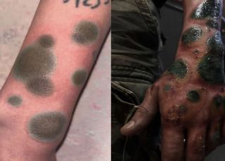Tatuagens que imitam manchas de mofo na pele viralizam e dividem opiniões nas redes sociais