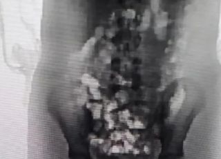 Mãe é presa após colocar 32 porções de skunk no corpo da própria filha de 13 anos para entrar em presídio