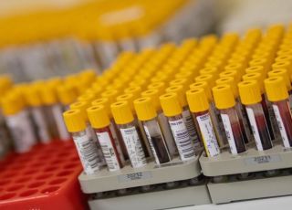 Estudo brasileiro identifica dez proteínas no sangue que podem antecipar risco de hipertensão pulmonar