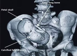 Mulher de 42 anos passa por cirurgia após descobrir feto calcificado no abdômen
